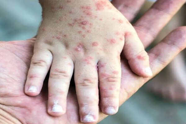 بازگشت سرخک به فارس؛ چرخه واکسیناسیون سرخک باید سریعتر تکمیل شود