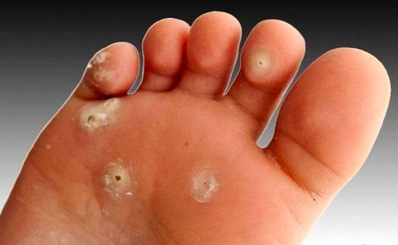 میخچه» را چگونه درمان کنیم؟