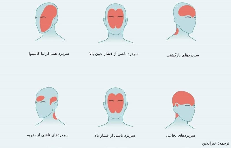 درد در نواحی مختلف سر ناشی از چیست؟/ از سردرد خوشه‌ای تا سردرد رعد و برقی+ تصاویر